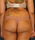 Feel Beautiful - Liposuction Back-Waist-Front 206 - Before Photo
